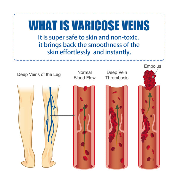 Intravenous Massage Cream Relieves Vascular Leg Massage Treatment